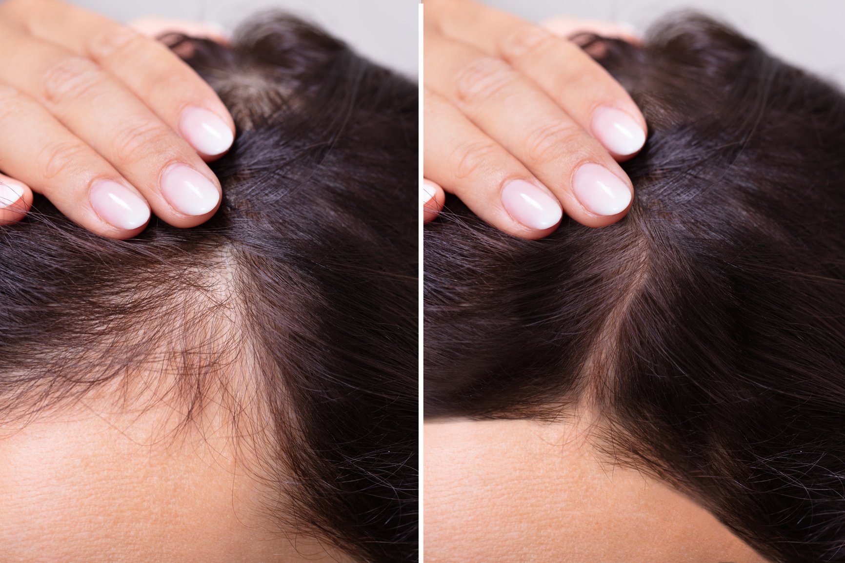 Before And After Hair Loss Treatment